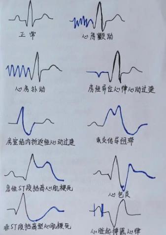 如何看心电图