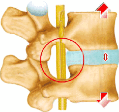 腰椎盘突出压迫神经导致腰痛动态图