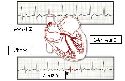 健康管理-心律失常