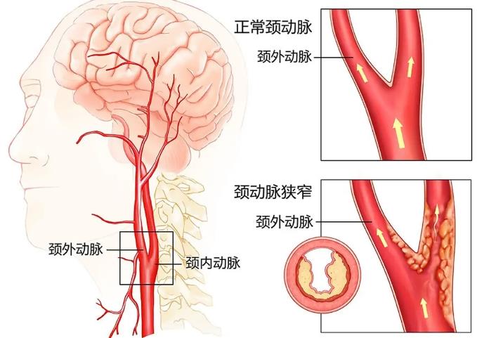 颈动脉 颈外动脉图和颈内动脉图（正常和异常）