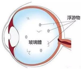 飞蚊症的自我调理