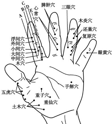 木一木二穴 位置图-眼睛疾病穴位疗法